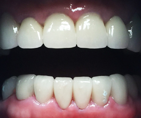Dental crowns