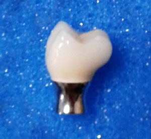 Dental Implant