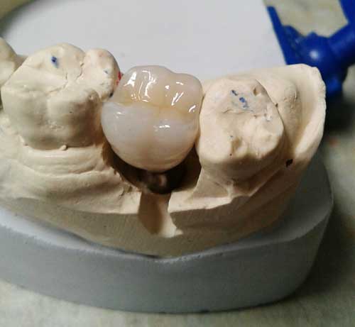 Dental Implant