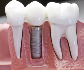 Dental implant